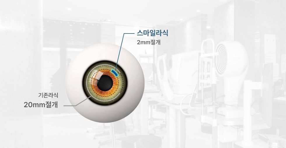 스마일라식