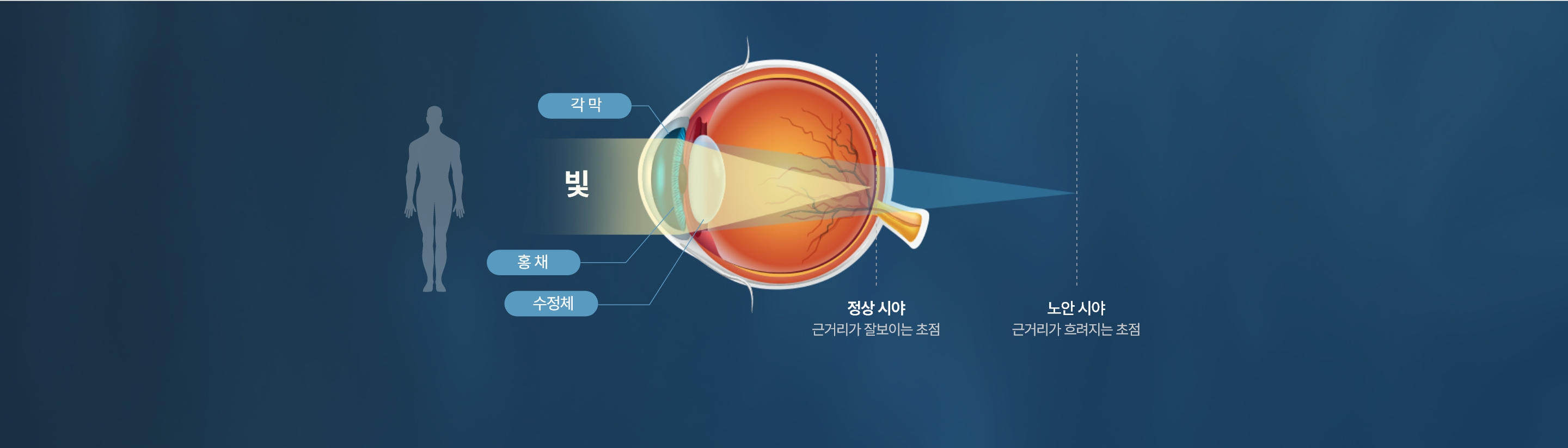 백내장 설명